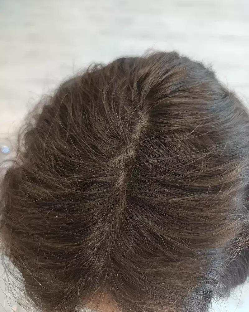 Traitement anti-poux dans le centre À Pas de Poux à La Roche-sur-Yon